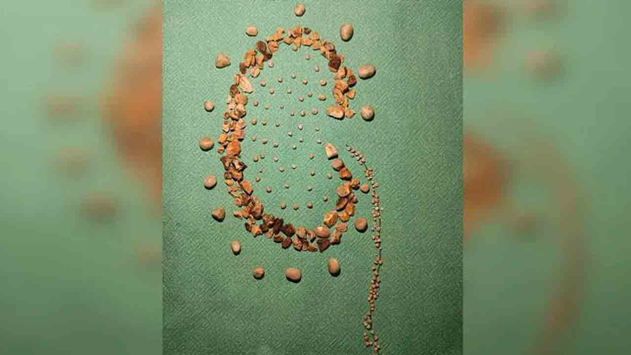 Hyderabad | ఓ వ్య‌క్తి కిడ్నీలో 154 రాళ్లు.. శ‌స్త్ర‌చికిత్స విజ‌య‌వంతం