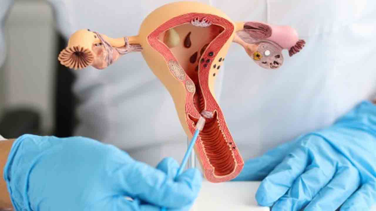 Cervical Cancer