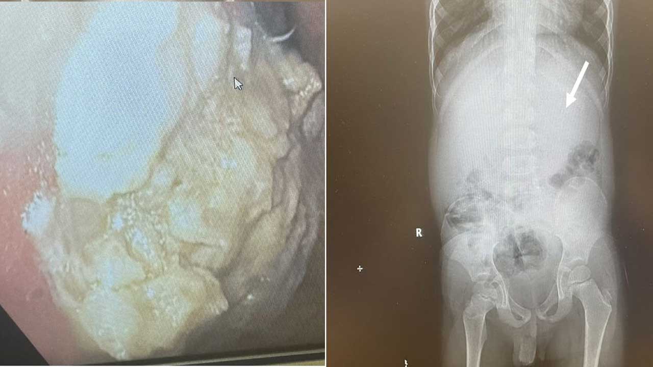 Boy swallows chewing gums | నలభై చూయింగ్‌ గమ్స్‌ మింగిన ఐదేళ్ల బాలుడు.. ఆఖరికి ఏమైందో తెలుసా..?