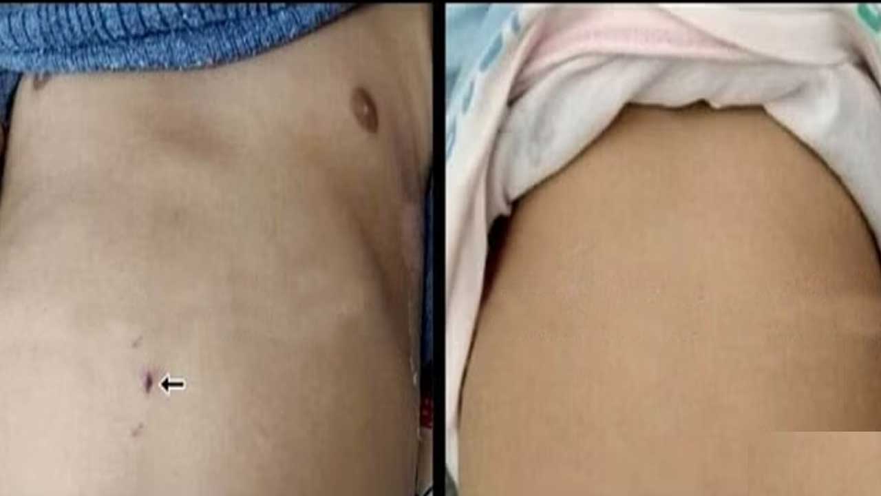 Kidneys Surgery | ఢిల్లీ వైద్యుల  ఘనత..! మూడు నెలల చిన్నారికి ఏకకాలంలో రెండు కిడ్నీలకు శస్త్ర చికిత్స..!