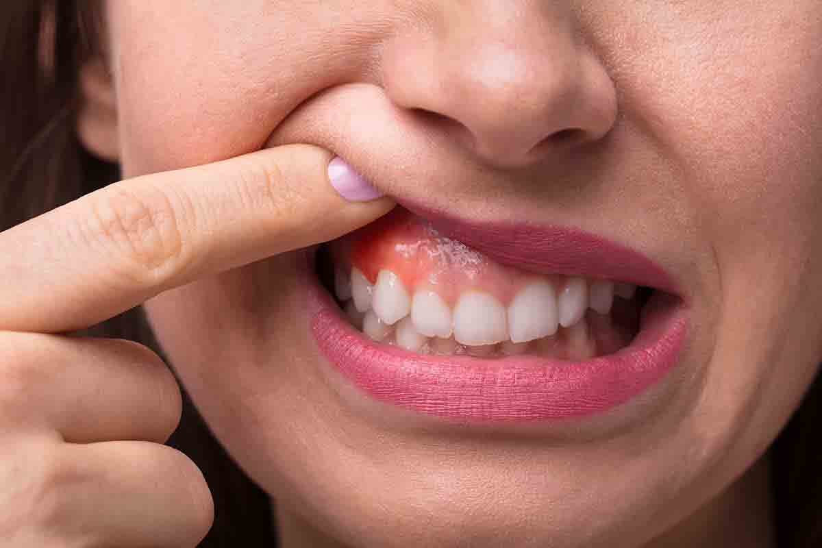 Oral Cancer