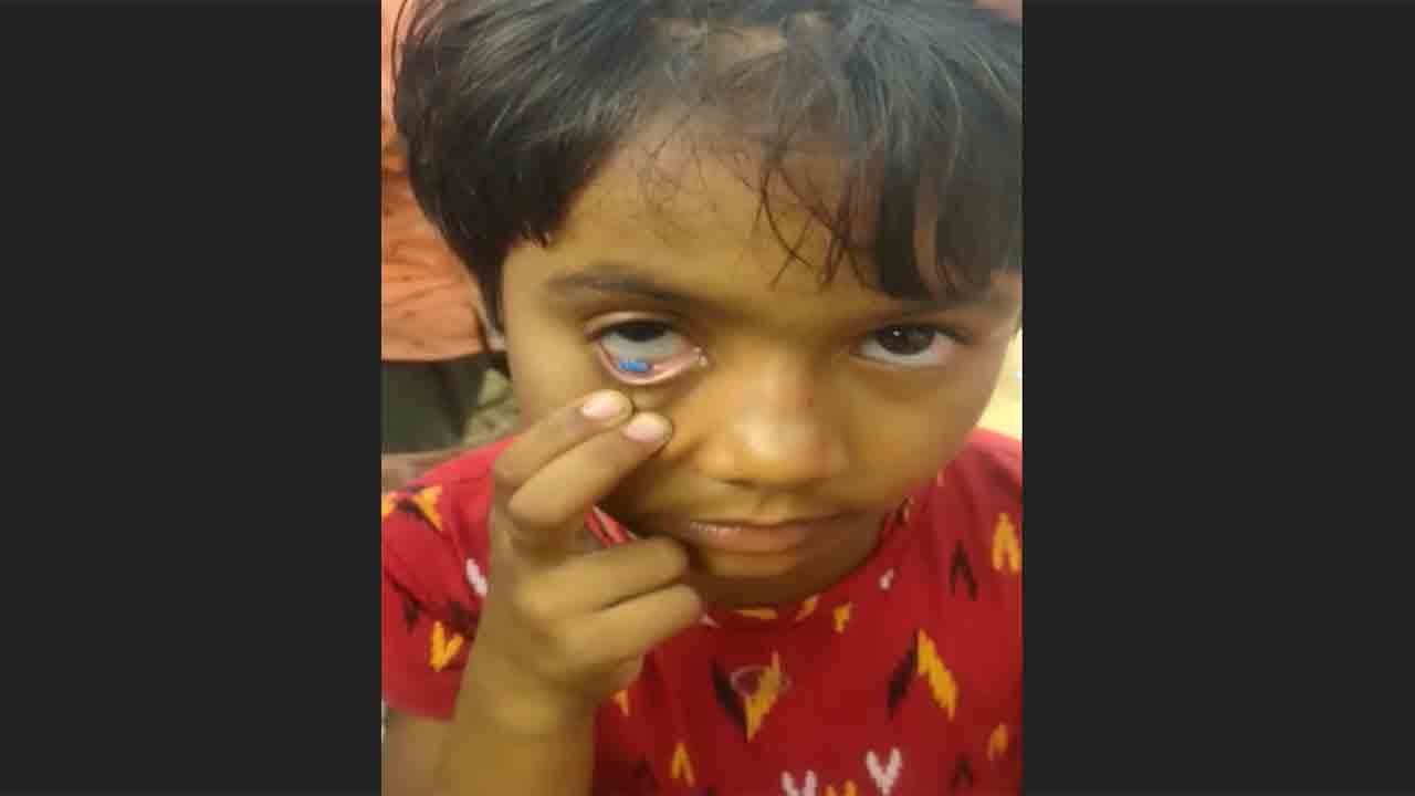 Rice, paper bits from girl’s eye | ఆరేళ్ల బాలిక కంటి నుంచి బియ్యపు గింజలు, పేపర్‌ ముక్కలు.. వీడియో వైరల్‌