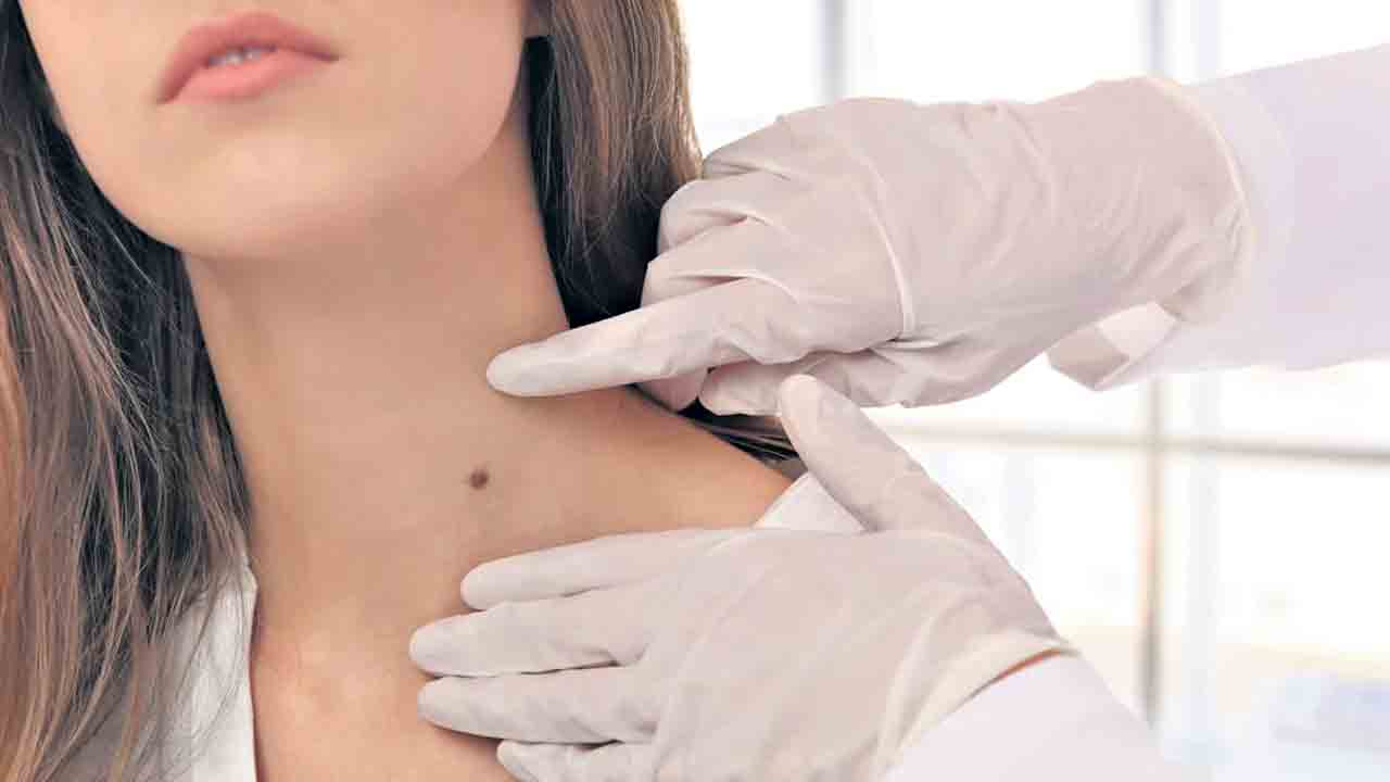 స్కిన్‌ ట్యాగ్స్‌ ఎందుకొస్తాయి?