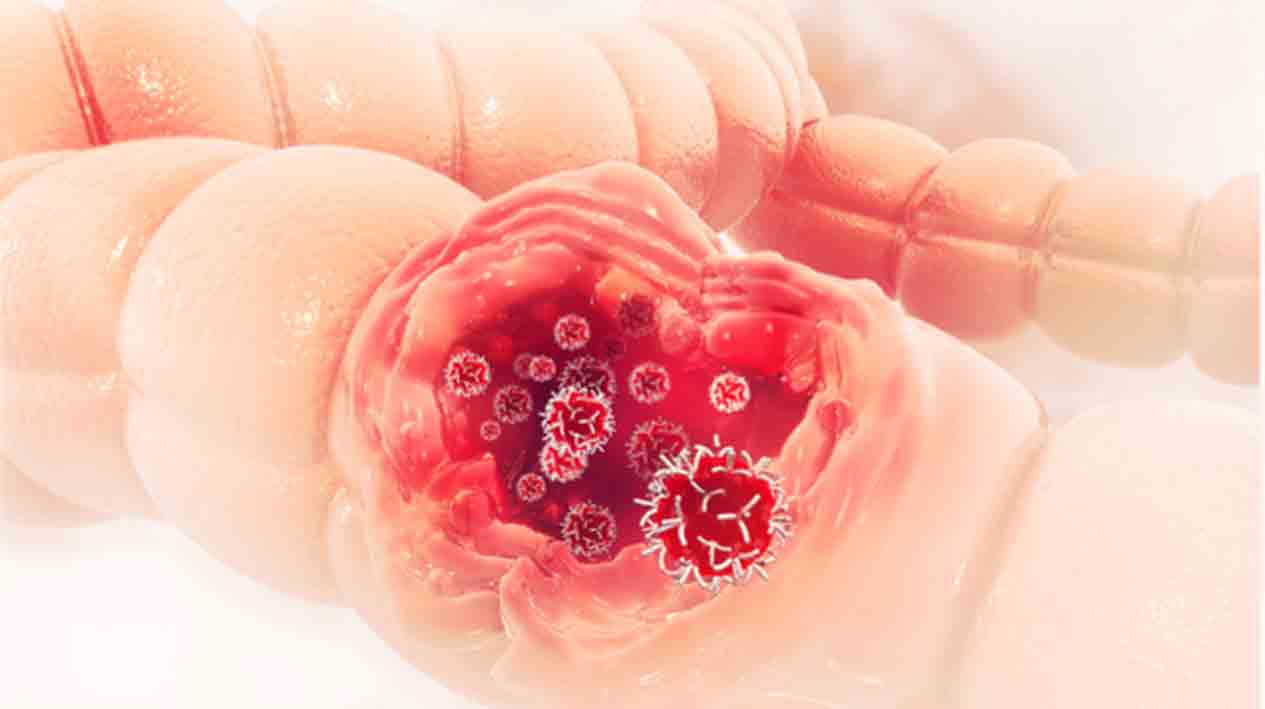 Colorect Cancer