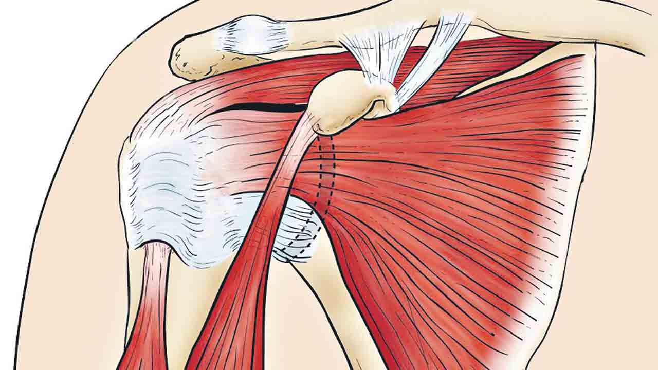 Frojen Shoulder
