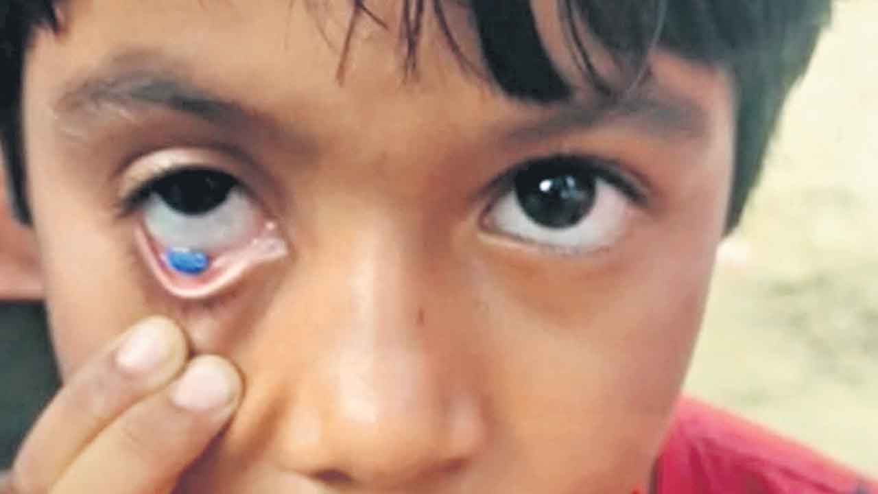 Khammam |  చిన్నారి కంట్లో నుంచి రాళ్లు, గింజలు.. అలవాటుగా పాపే కంట్లో పెట్టుకుంటుందన్న వైద్యులు