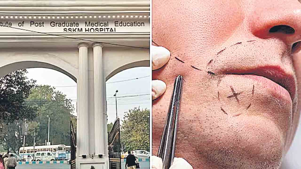 Transplantation |  గడ్డం ట్రాన్స్‌ప్లాంట్లకు అనూహ్య డిమాండ్‌.. ఎందుకో తెలుసా?