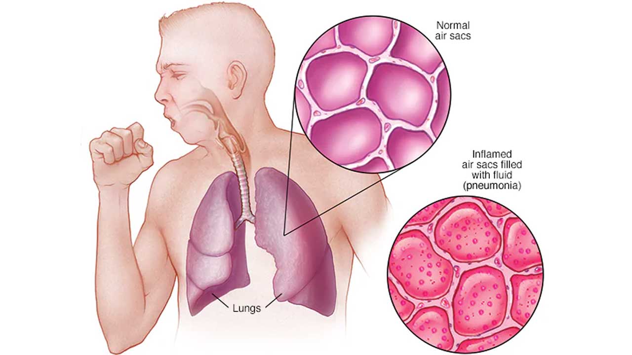మీరు కట్టుడుపండ్లు వాడుతున్నారా.. అయితే జాగ్రత్తగా ఉండాల్సిందే!