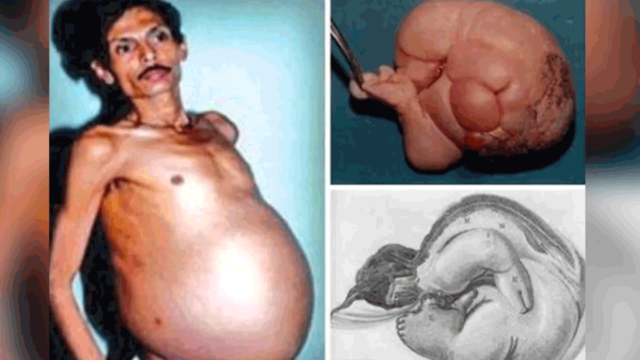 Maharashtra | 36 ఏళ్లుగా కవల సోదరుడి పిండాన్ని మోసిన వ్యక్తి.. వైద్య శాస్త్రంలోనే అరుదైన ఘటన