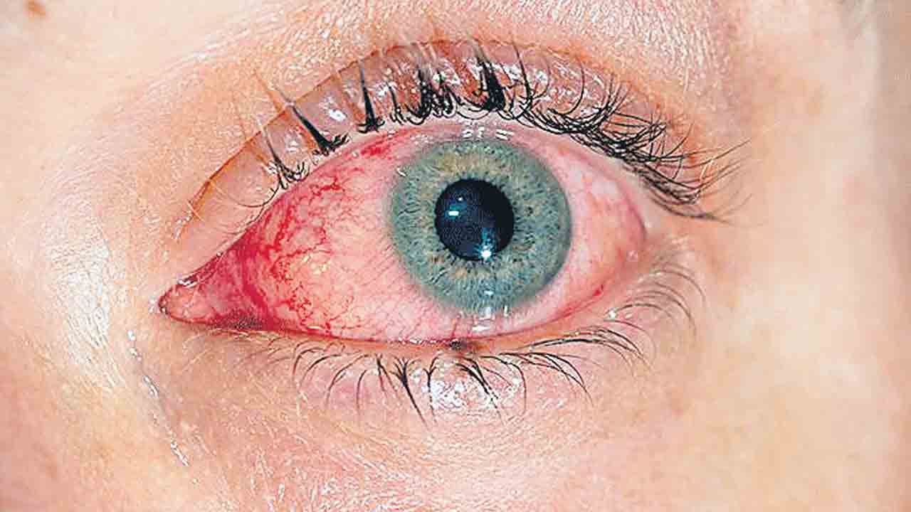 Pink Eye | వర్షాల నేపథ్యంలో తెలుగు రాష్ట్రాల్లో భారీగా పెరుగుతున్న కండ్ల కలక కేసులు.. ల‌క్ష‌ణాలు ఇవే..!