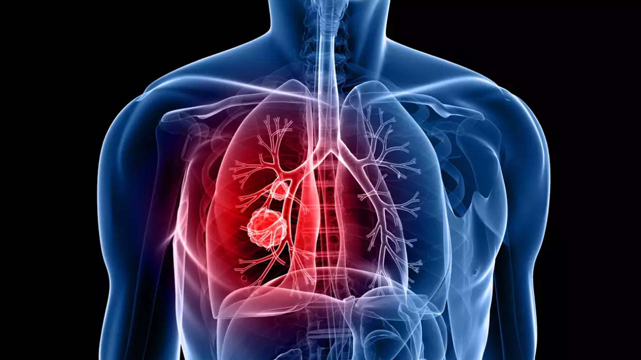 World Lung Cancer Day | పెరుగుతున్న ఊపిరితిత్తుల క్యాన్సర్‌ ముప్పు..! ఈ తప్పులు మీరూ చేస్తున్నారా..?
