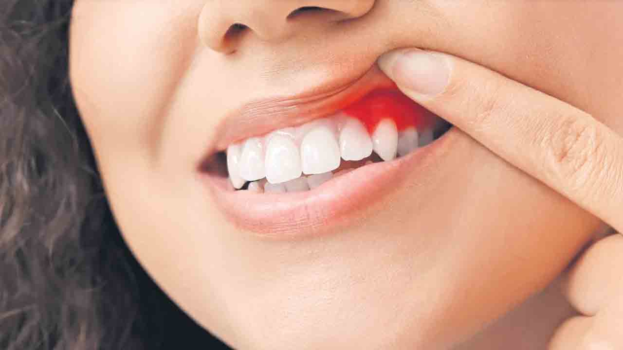 Gingivitis | పండ్ల మధ్య సందులు రావడానికి కారణమిదే.. జాగ్రత్తలు తీసుకోండి..