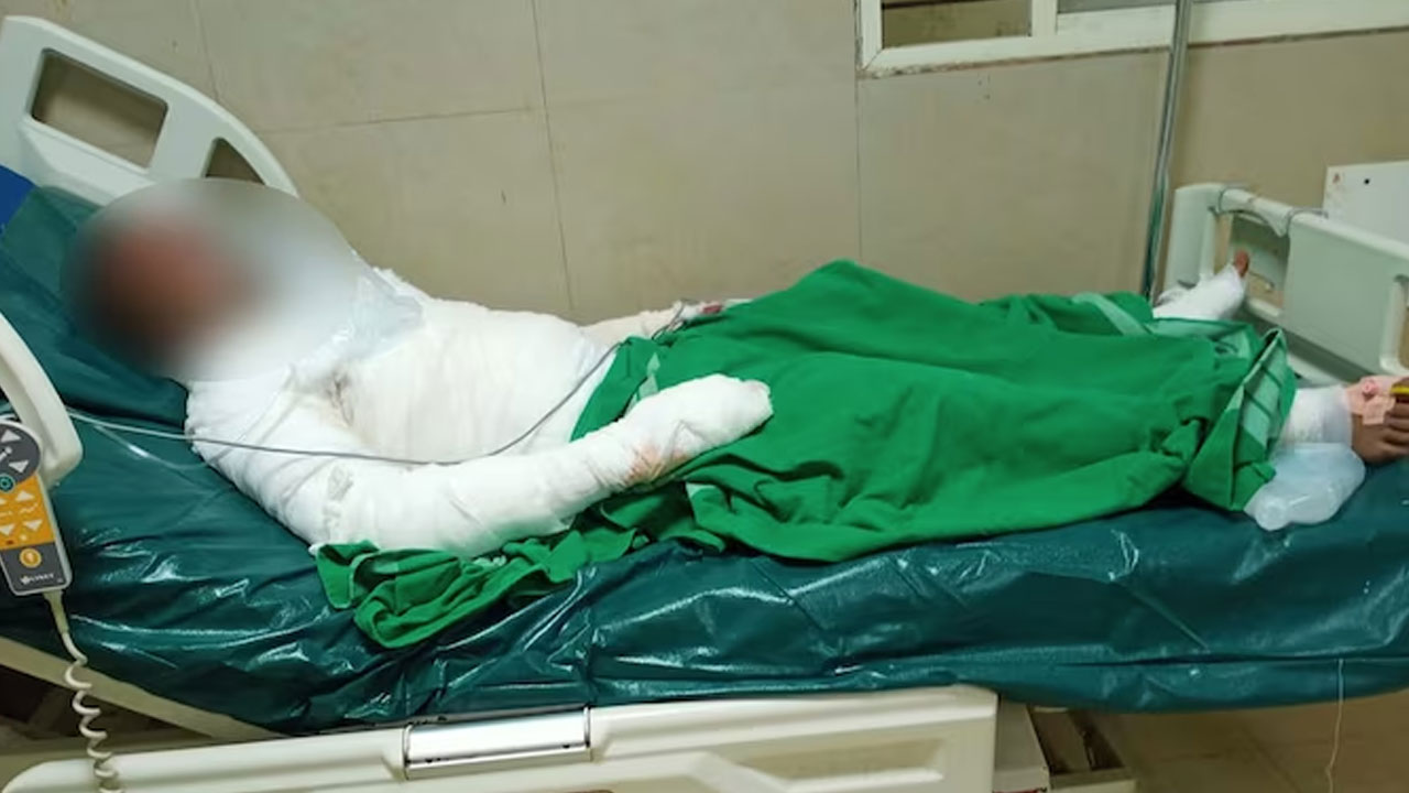 Karnataka | బంధువుతో ప్రేమాయ‌ణం.. ఇంజినీరింగ్ విద్యార్థికి నిప్పు