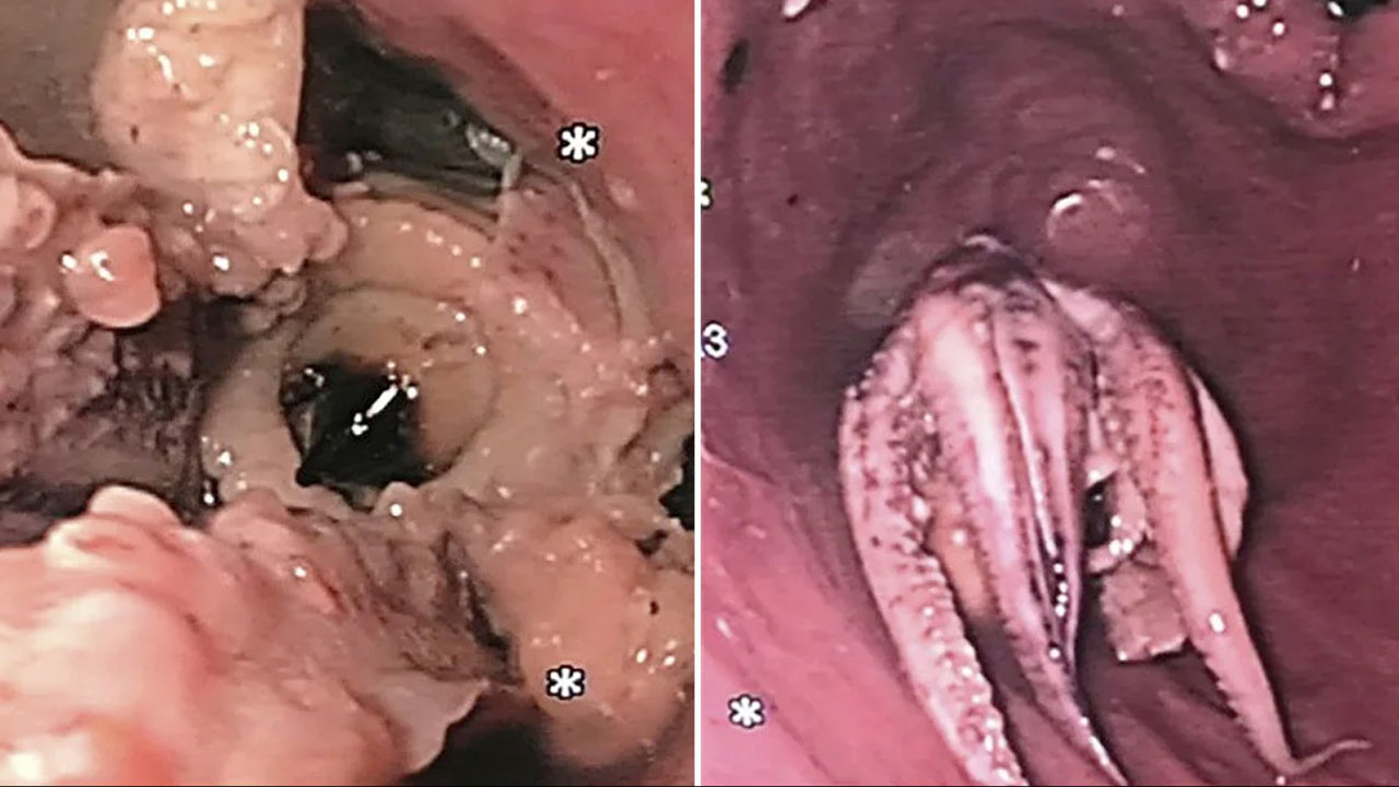 Octopus | మ‌నిషి గొంతులో ఇరుక్కున్న ఆక్టోప‌స్.. ఆ త‌ర్వాత ఏం జ‌రిగిందంటే..?