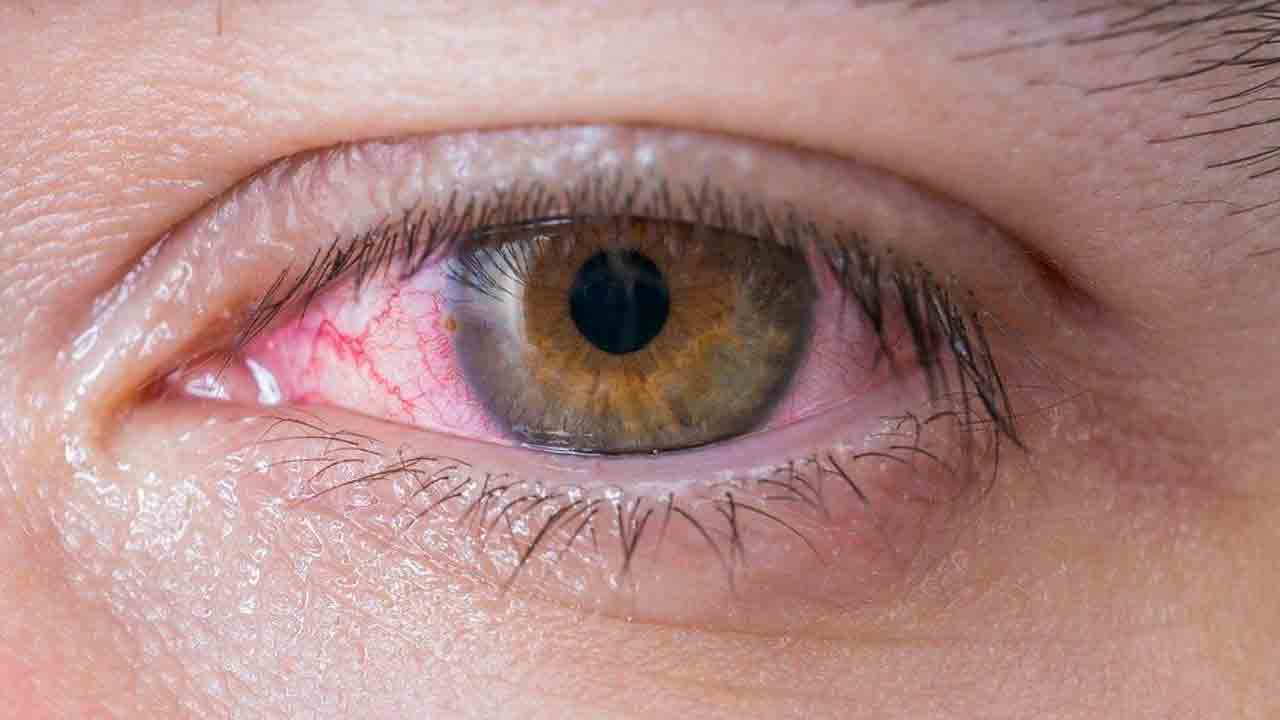 కండ్ల కలకలం టెన్షన్‌ వద్దు..