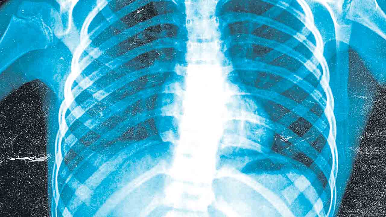 ఛాతీ ఎక్స్‌రేతో వయసు అంచనా