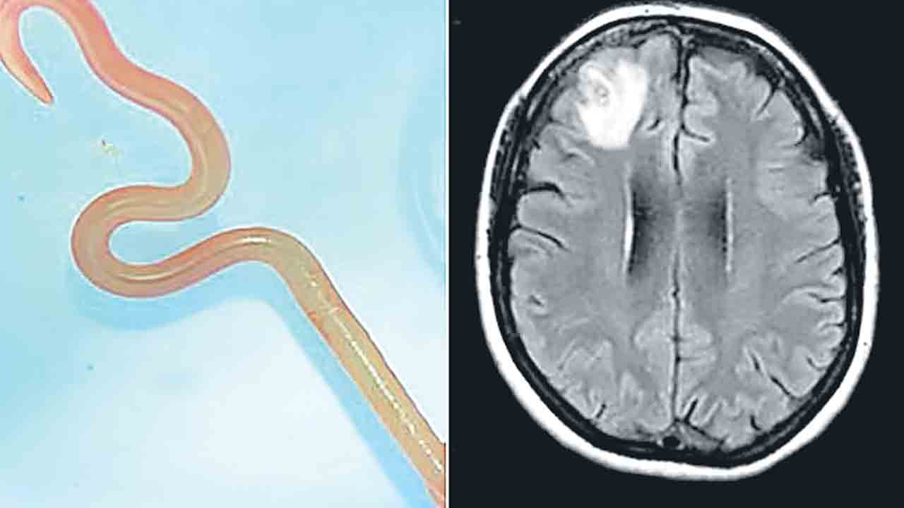 వృద్ధురాలి మెదడులో ఏలికపాము