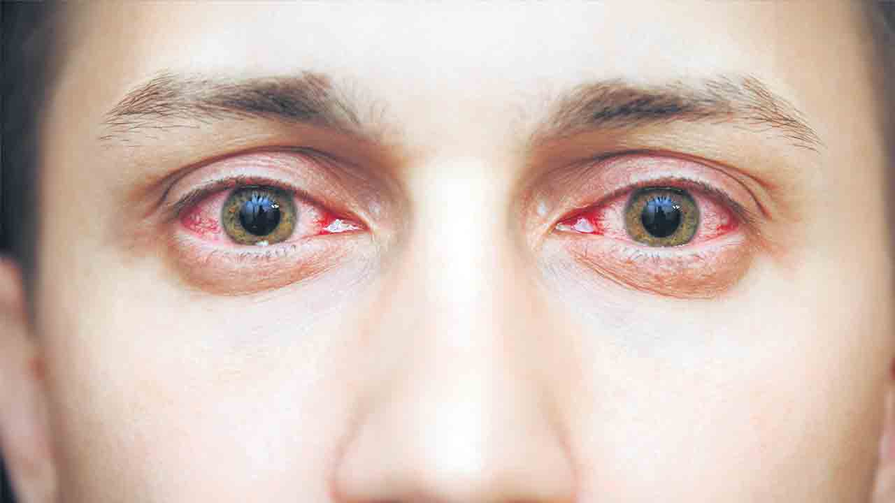 Pink Eye |  కండ్ల కలక ఎలా వస్తుంది? ఇది రాకుండా ఎలాంటి జాగ్రత్తలు తీసుకోవాలి? ఒకవేళ వస్తే ఏం చేయాలి?