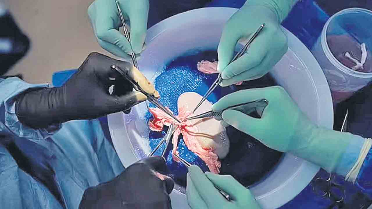 Kidney Transplant | మనిషికి పంది కిడ్నీ అమర్చిన అమెరికా డాక్టర్లు.. ఆ తర్వాత ఏం జరిగింది?