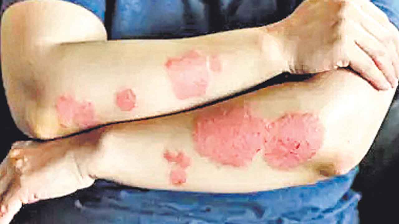 Psoriasis |  జీర్ణవ్యవస్థ సరిగా లేకపోయినా సోరియాసిస్‌ వస్తుంది.. హెచ్చరిస్తున్న వైద్య నిపుణులు