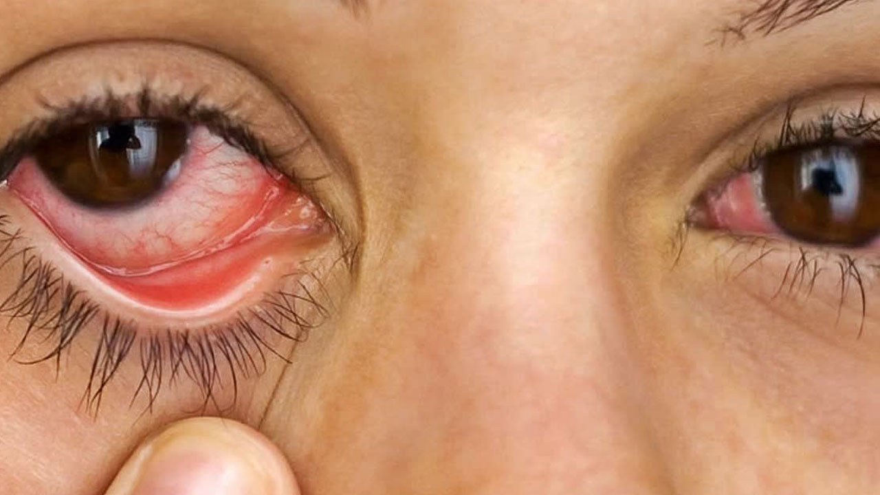 Conjunctivitis: హిమాచ‌ల్‌లో ఒక్క నెల‌లోనే 38 వేల కండ్ల‌క‌ల‌క కేసులు న‌మోదు