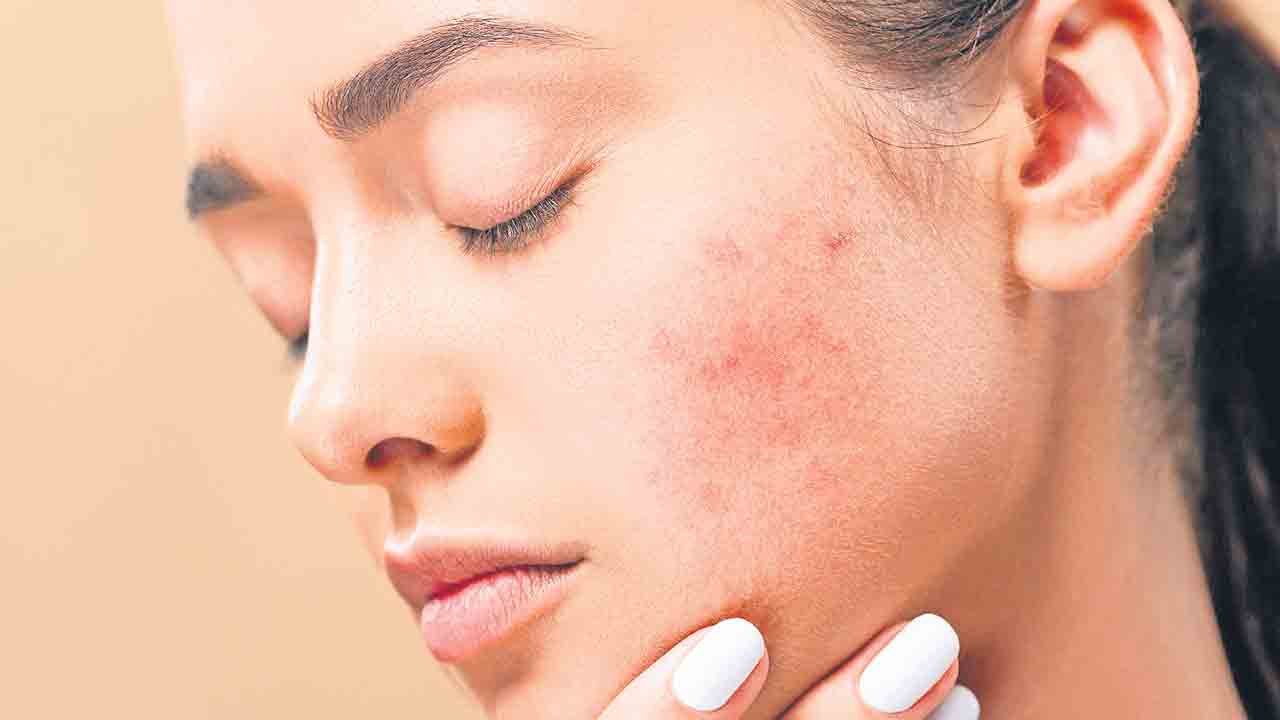 మచ్చలకు చికిత్స ఉందా?