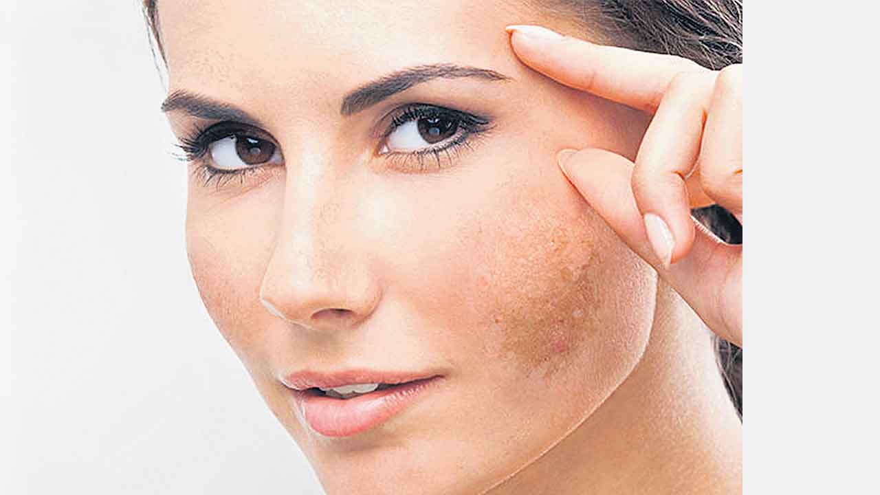 Health | గర్భధారణ సమయంలో చెంపలపై మచ్చలు ఎందుకొస్తాయి? రాకుండా ఉండాలంటే ఏం చేయాలి?