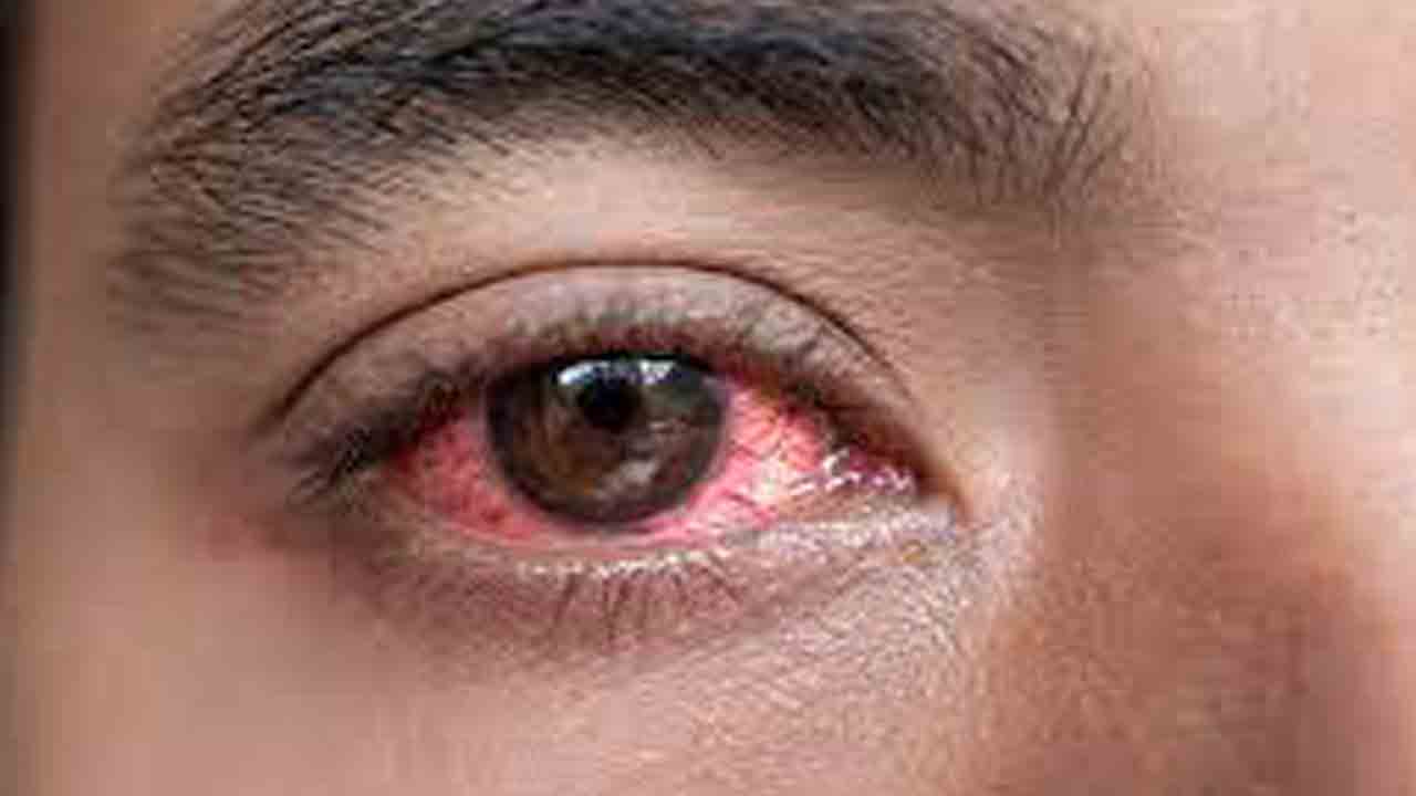 కండ్ల కలకలం..