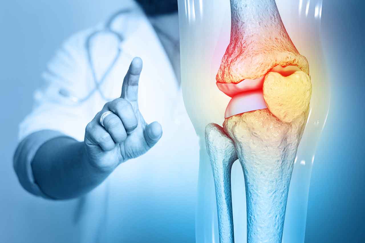 Osteoarthritis1