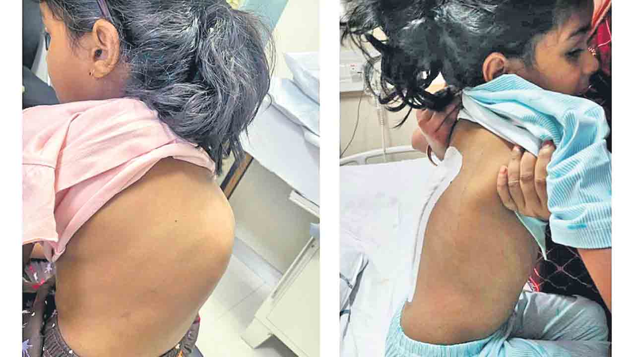 KIMS | కిమ్స్‌లో అరుదైన శస్త్రచికిత్స.. తొమ్మిదేండ్ల బాలికకు కొత్త జీవితమిచ్చిన వైద్యులు