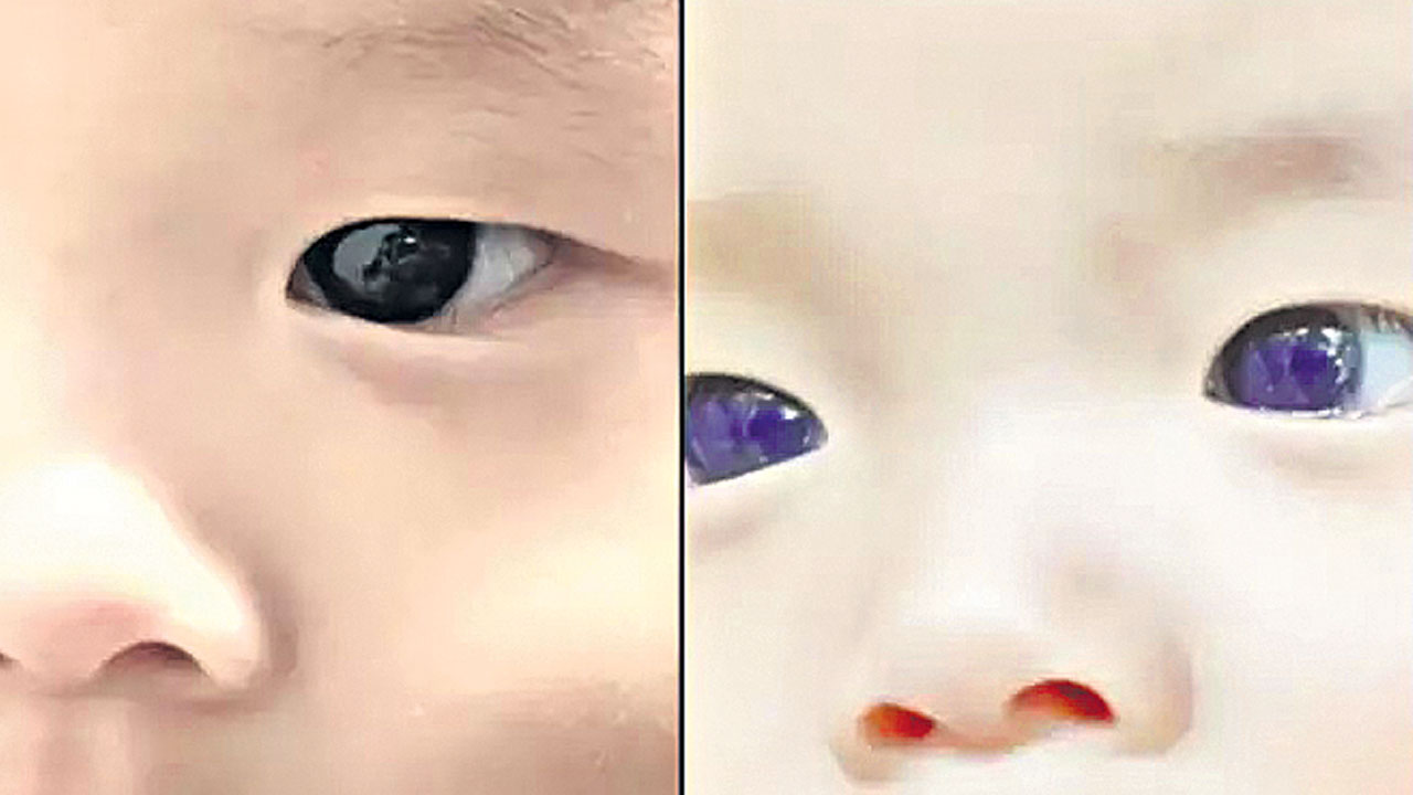 కొవిడ్‌ చికిత్స తర్వాత నీలిరంగులోకి కండ్లు