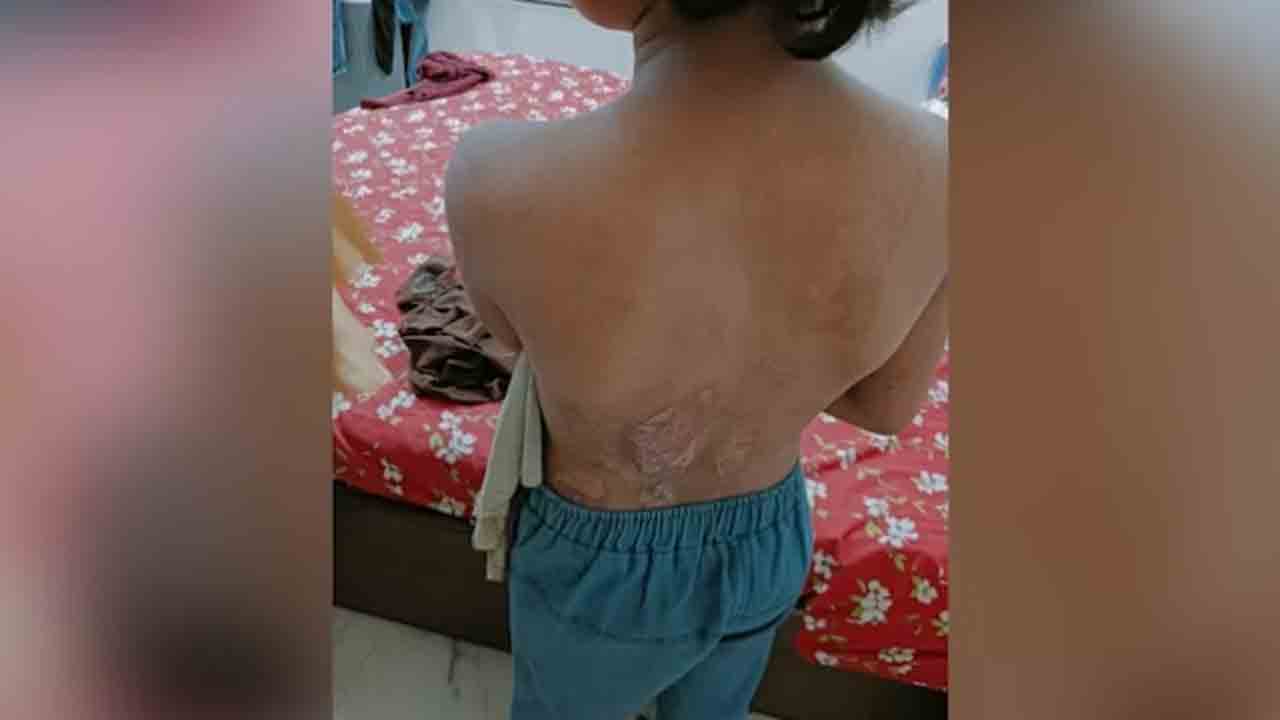 Minor domestic help tortured | ఇంటి పనులు చేసే బాలికకు చిత్రహింసలు.. సిగరెట్‌, కాల్చిన   అట్లకాడతో వాతలు పెట్టిన దంపతులు