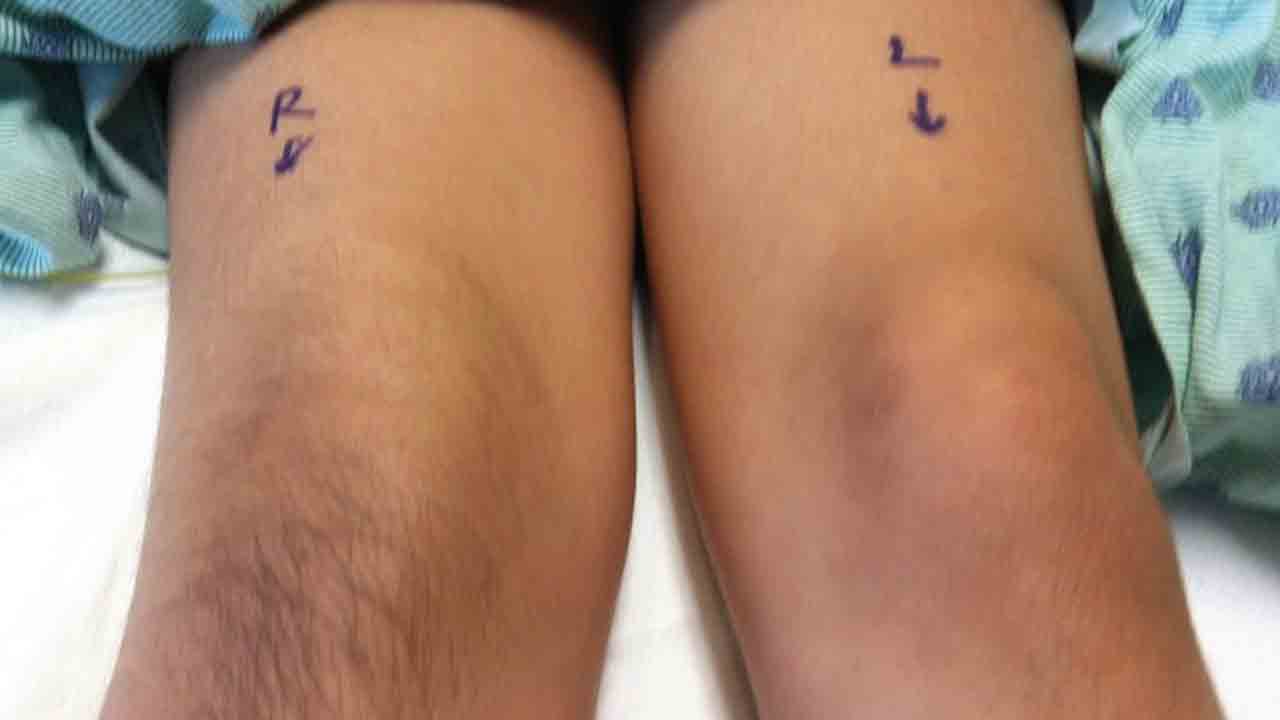 11 ఏండ్ల చిన్నారికి ‘పెయిన్‌ సిండ్రోమ్‌’