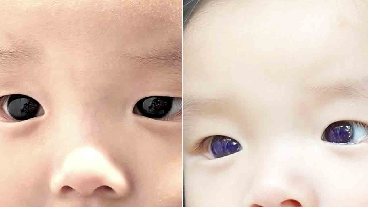 Covid 19 Treatment | కరోనా ట్రీట్‌మెంట్‌తో నీలిరంగులోకి మారిన 6 నెలల పసికందు కళ్లు