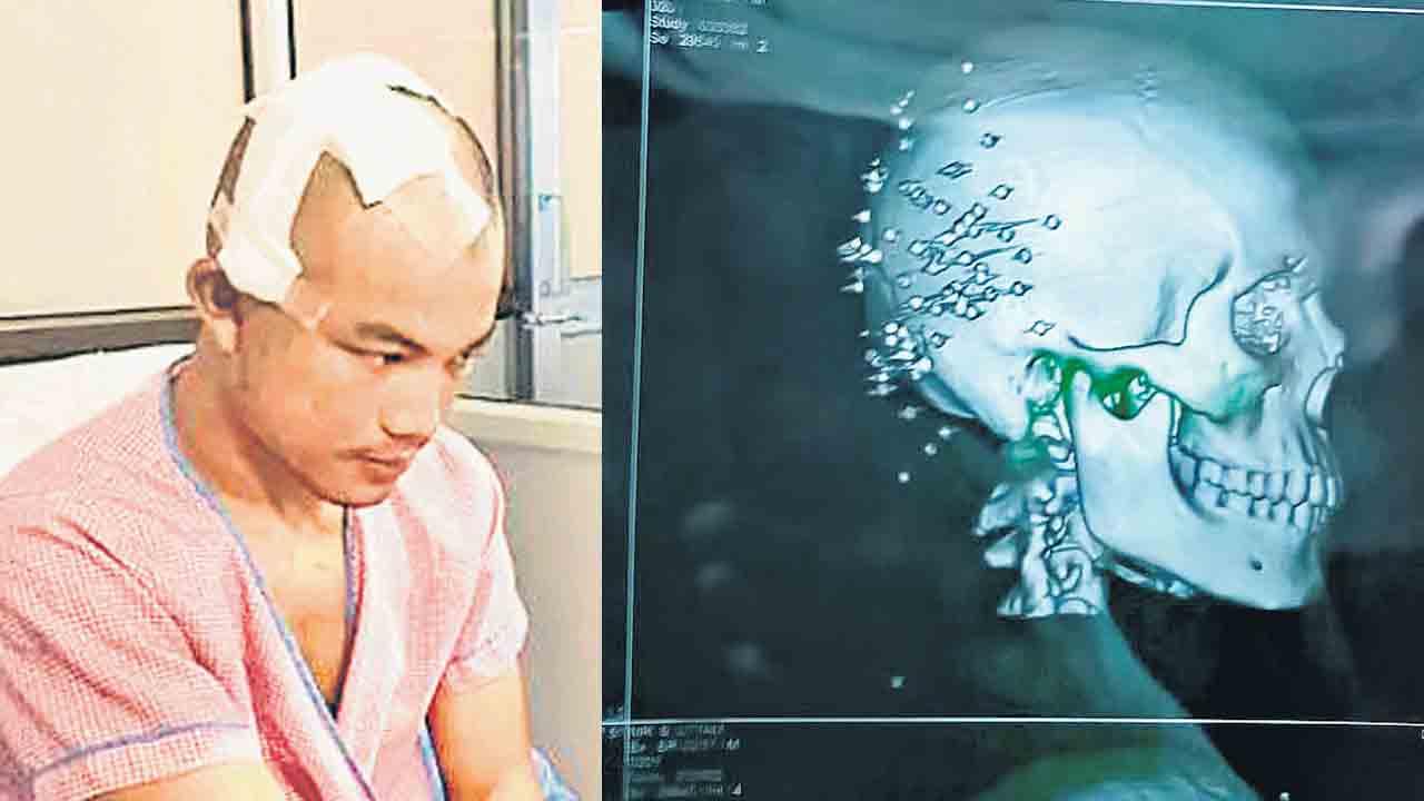 Manipur Violence | జాతీయ క్రీడాకారుడి తలలో 61 మేకులు.. వైరల్‌గా మారిన ఫొటోలు