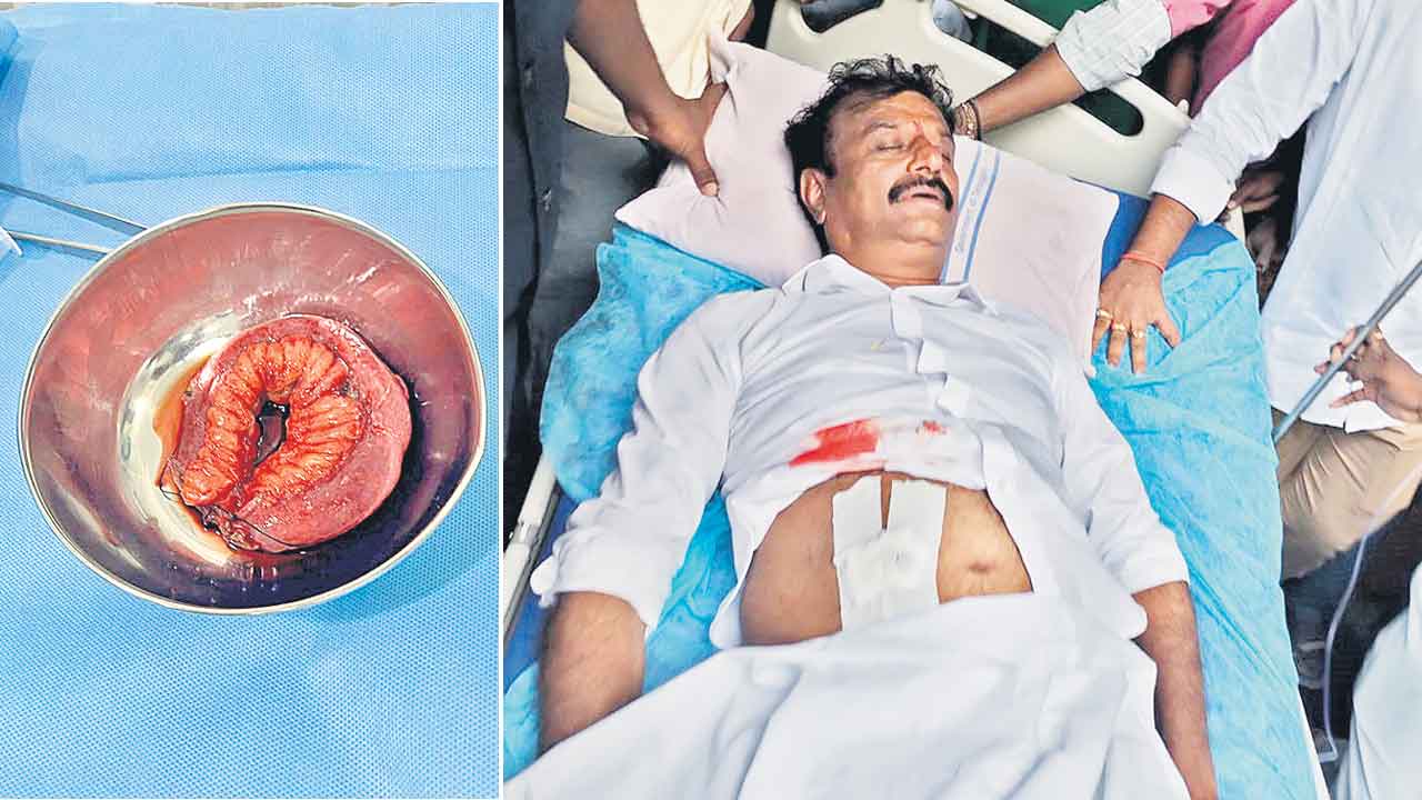 Kotha Prabhakar Reddy | కొత్త ప్రభాకర్‌రెడ్డికి 4 గంటల సుదీర్ఘ సర్జరీ.. చిన్నపేగును 10 సెం.మీ. కట్‌ చేసిన వైద్యులు