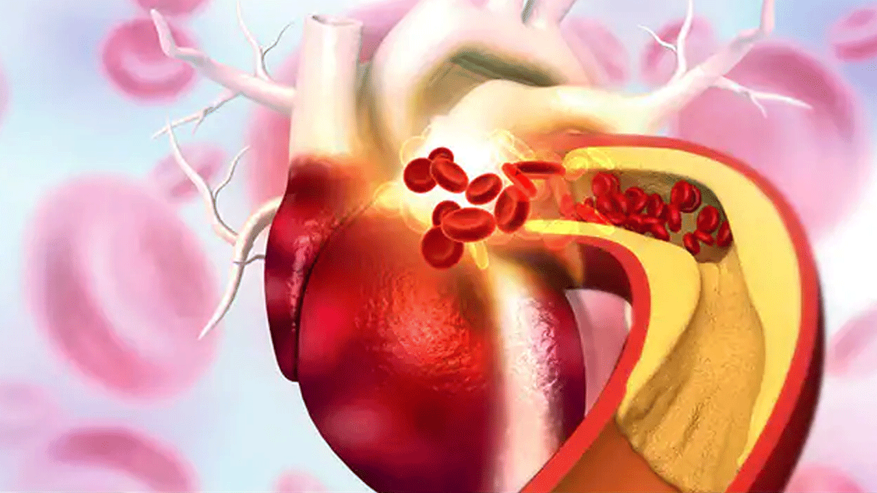 High Cholesterol Levels | అధిక కొలెస్ట్రాల్ లెవెల్స్తో హృద్రోగ ముప్పు : స్టాటిన్స్తో చెక్
