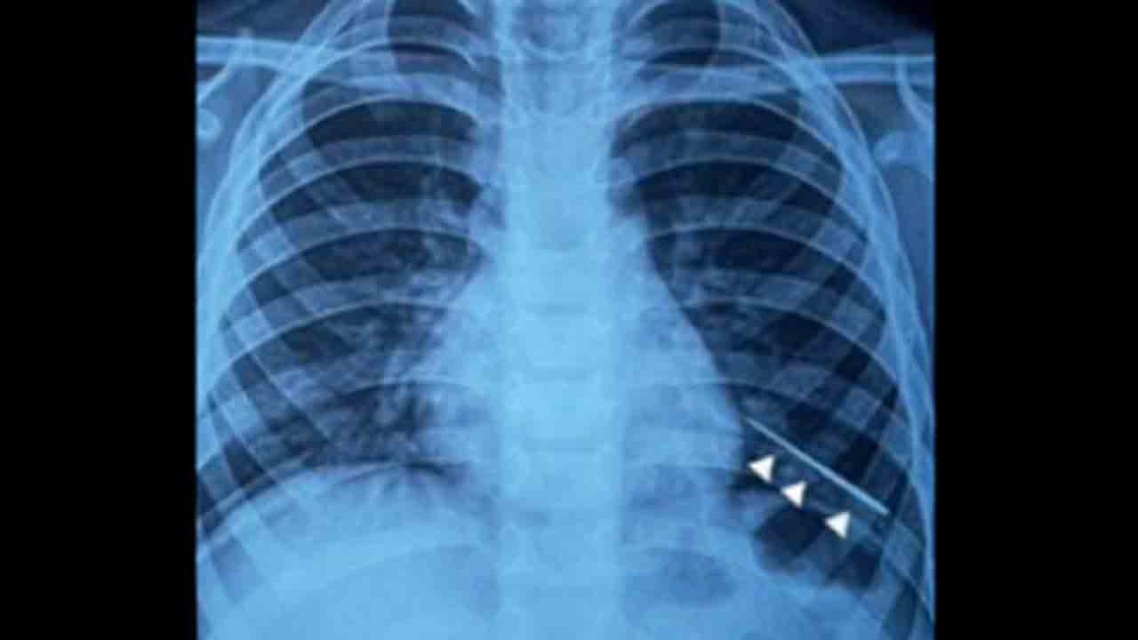 needle in boy’s lung | సూది మింగిన బాలుడు.. లంగ్‌లో చిక్కుకోగా అయస్కాంతం ద్వారా బయటకు   తీసిన వైద్యులు