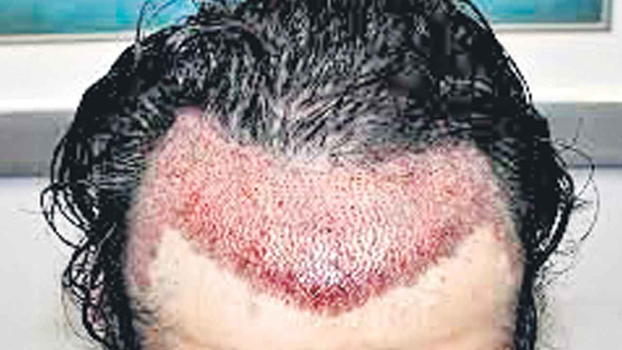 జుట్టు మార్పిడికి యమా క్రేజ్‌