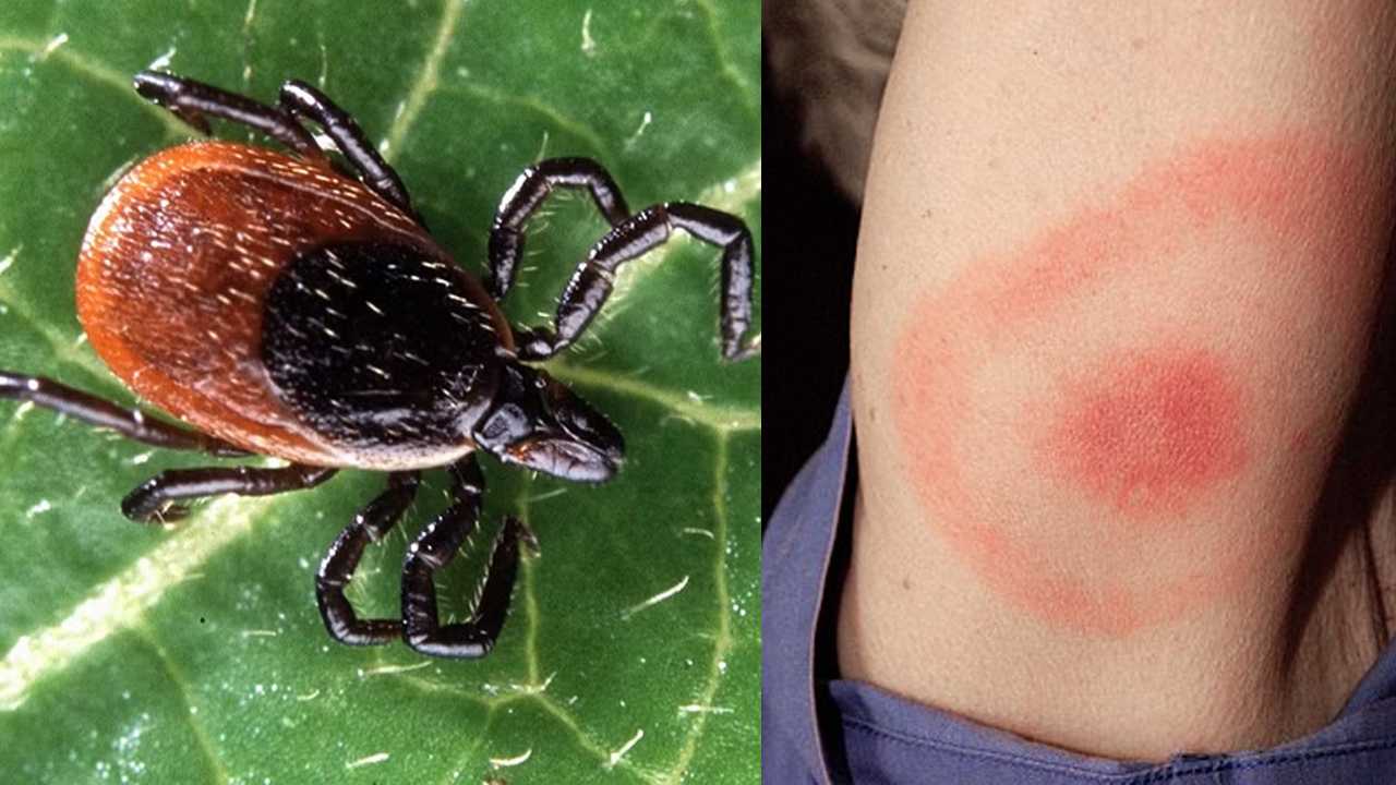 Lyme Disease | విస్తరిస్తున్న మరో అరుదైన వ్యాధి.. 144 మందికి లైమ్‌ డీసిజ్‌ పాజిటివ్‌..!