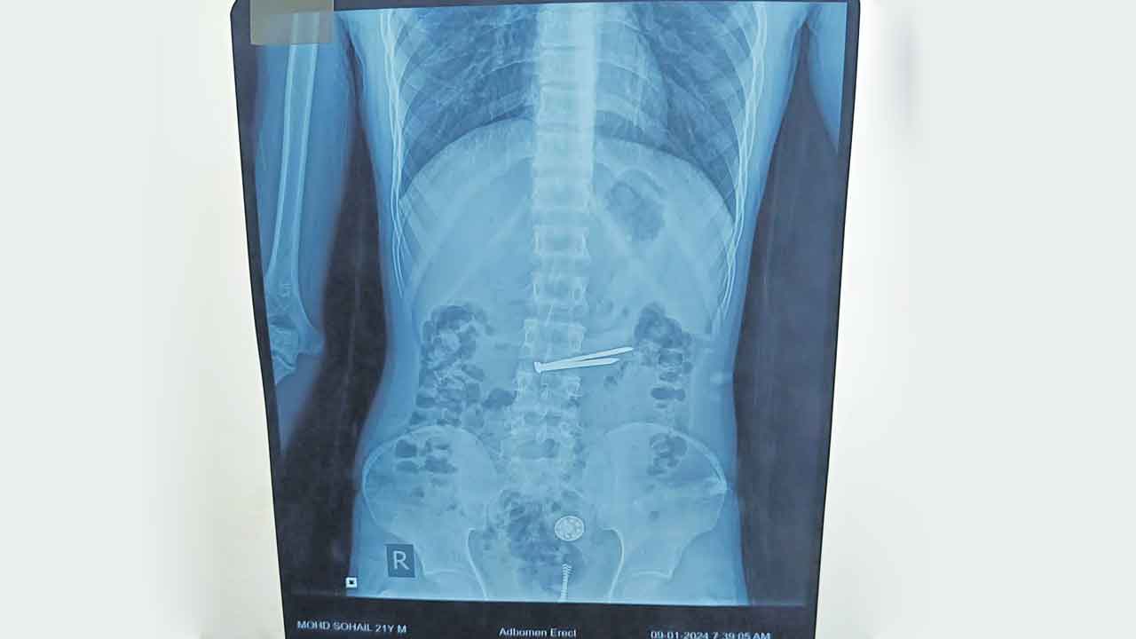 Khaidi patient | ఖైదీ కడుపులో గోర్లు, మేకులు.. ఎండోస్కోపీతో తొలగించిన ఉస్మానియా వైద్యులు