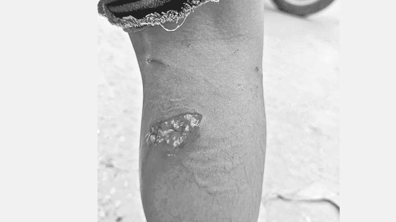 పీక్కుతింటున్నాయి నగరంలో వీధికుక్కల మూకుమ్మడి దాడి