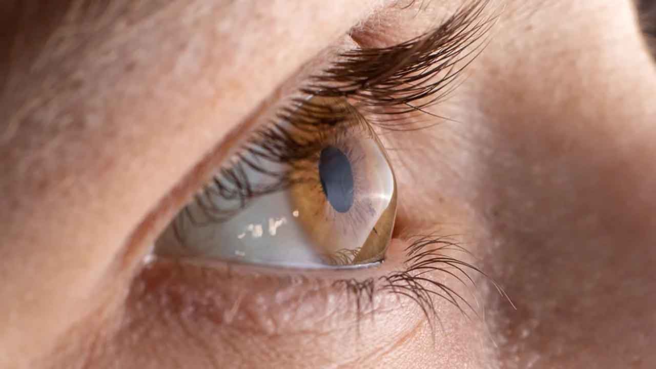 LV Prasad Eye Hospital | కార్నియాకు మూలకణ చికిత్స.. ఎల్వీప్రసాద్‌ దవాఖన వైద్యులకు పేటెంట్‌