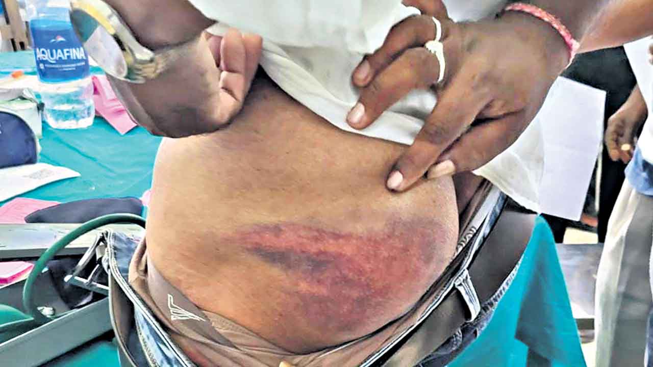 CM Revanth Reddy |  జై తెలంగాణ అన్నందుకు రోకలిబండలతో పోలీసుల థర్డ్‌ డిగ్రీ