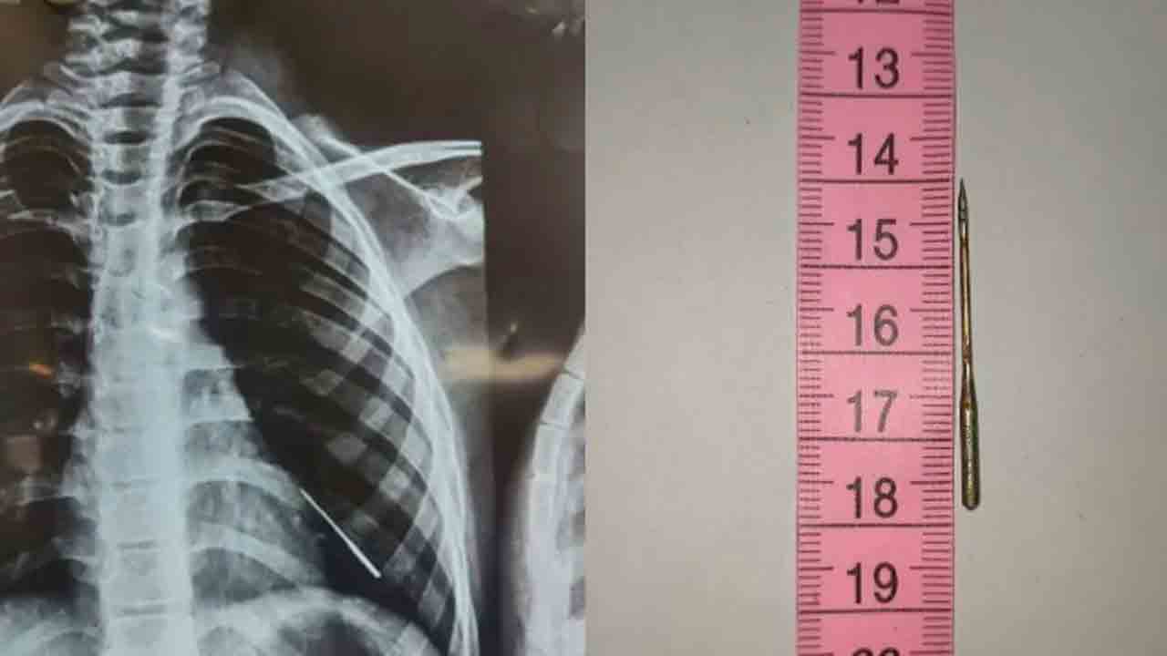 Needle in Boy Lungs | బాలుడి ఊపిరితిత్తుల్లో సూది.. వినూత్న ప్రక్రియ ద్వారా తొలగించిన వైద్యులు