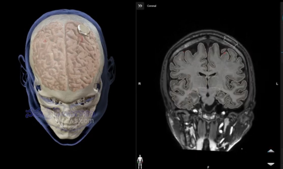 మెదడులో ‘చిప్’ సక్సెస్ అయ్యింది