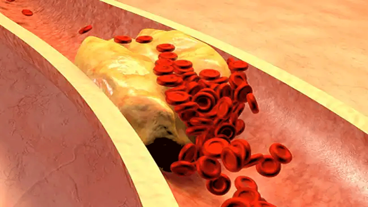 Bad Cholesterol Levels | కొలెస్ట్రాల్‌ను త‌గ్గించే ఆహార ప‌దార్ధాలివే..!