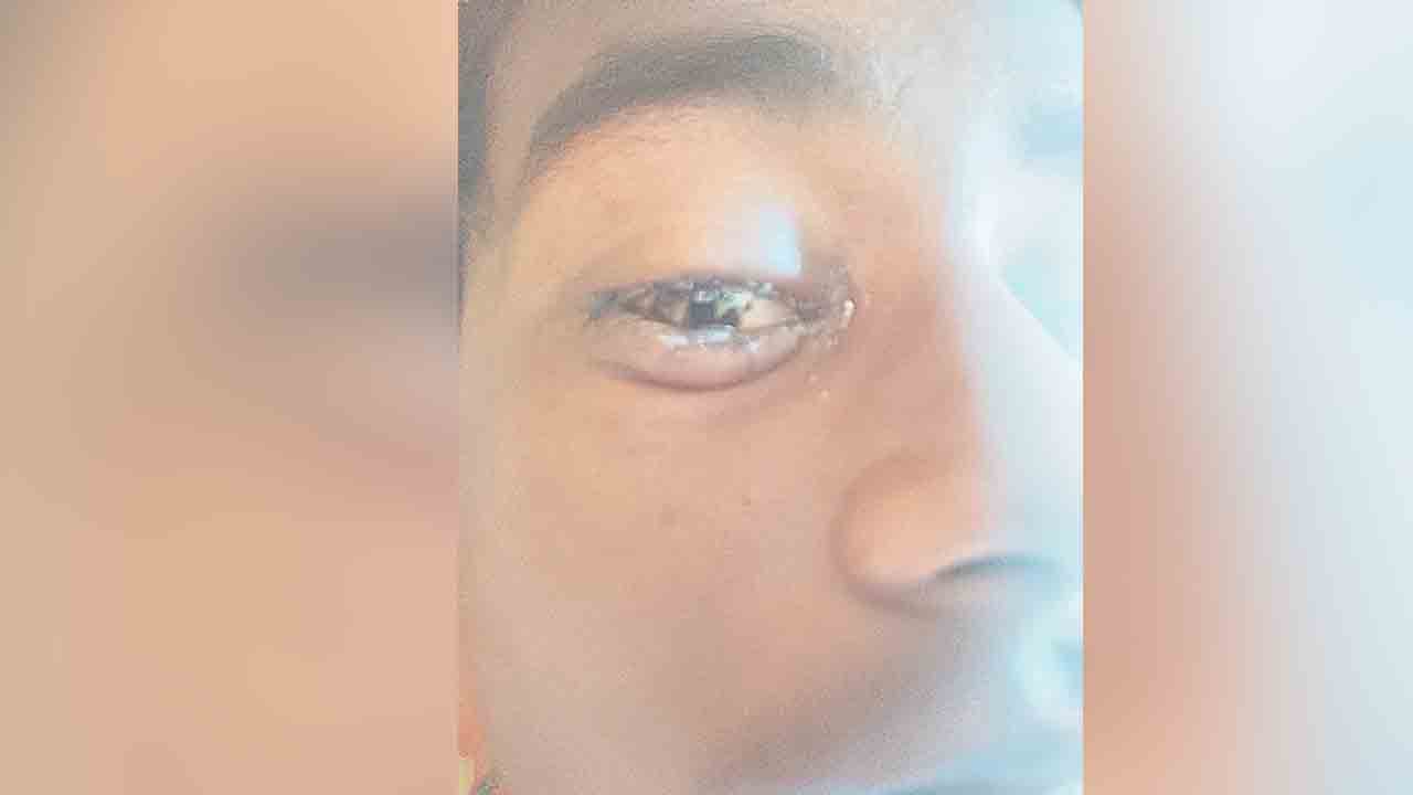 ఎక్కాలు చెప్పుడం లేదని కర్రతో కొట్టిన ఉపాధ్యాయుడు