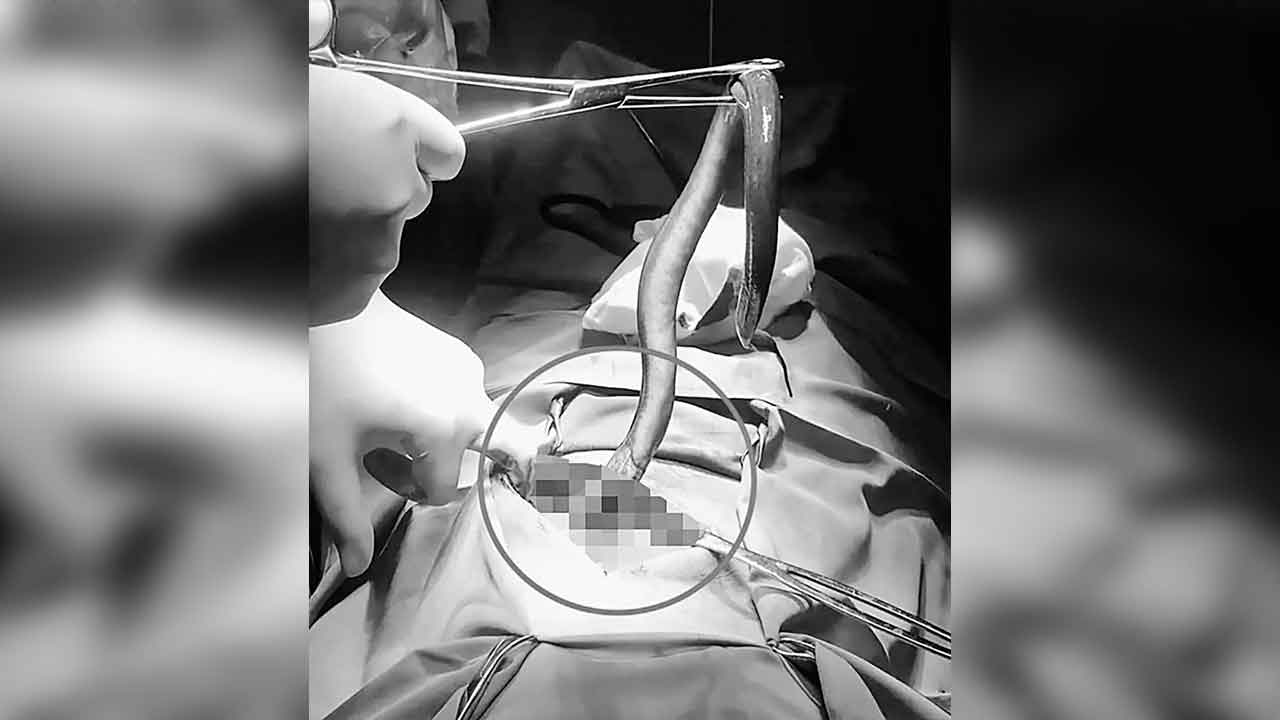 పేగులో పొడవు చేప.. సజీవంగా బయటకు..