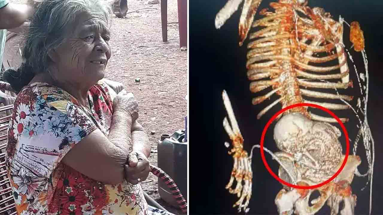 Daniela Vera | ఆశ్చర్యం.. 56 ఏండ్లుగా గర్భంతో మహిళ.. 81 ఏళ్ల వయసులో పిండం తొలగింపు..!